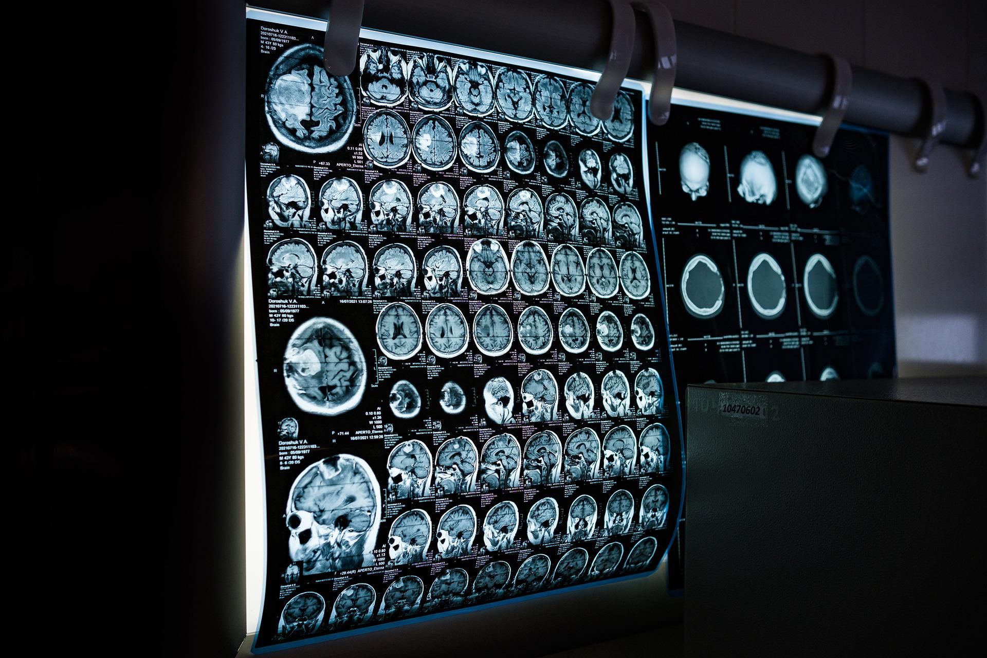 brain x-rays